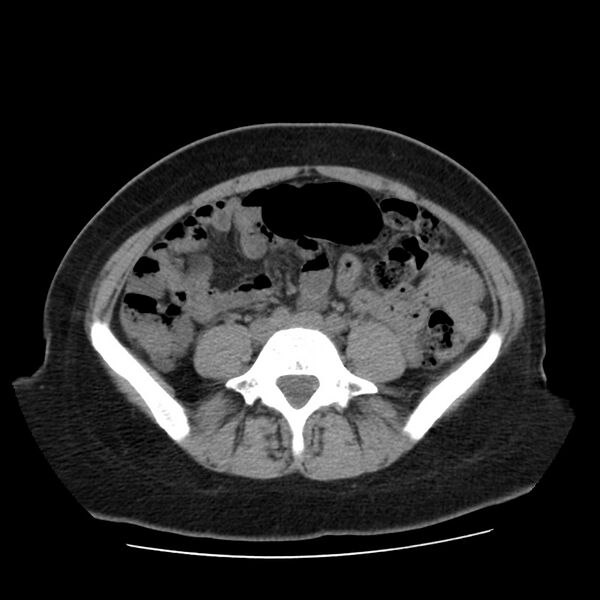 File:Autosomal dominant polycystic kidney disease (Radiopaedia 23061-23093 Axial non-contrast 44).jpg