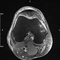 Avulsion fracture of the fibular head (Radiopaedia 74804-85808 Axial PD fat sat 15).jpg