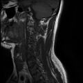 Axis fracture - MRI (Radiopaedia 71925-82375 Sagittal T1 2).jpg