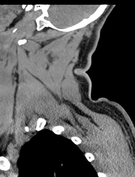 File:Axis peg fracture (type 3) and atlas lateral mass (type 4) fracture (Radiopaedia 37474-39324 D 11).png