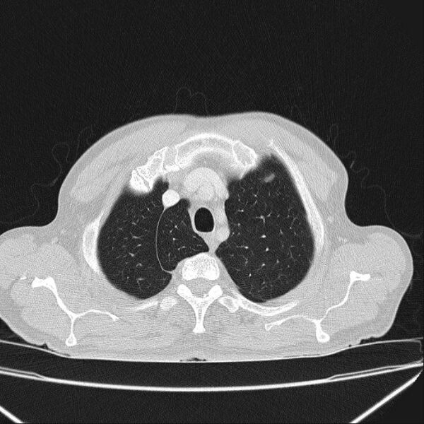 File:Azygos lobe (Radiopaedia 38259-40275 Axial lung window 12).jpg
