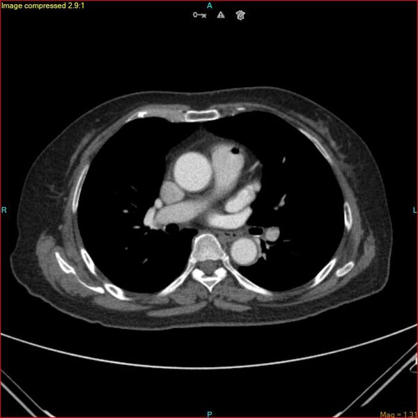 File:Azygos vein aneurysm (Radiopaedia 77824-90130 B 30).jpg