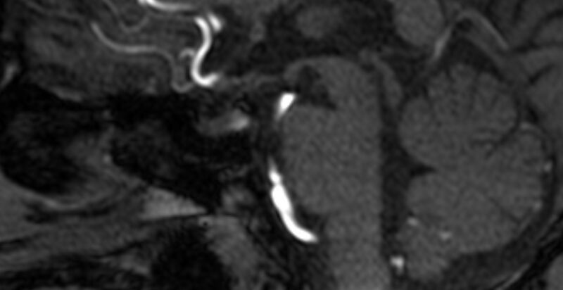 File:Basilar artery fenestration (Radiopaedia 74537-85455 Sagittal MRA TOF 19).jpg