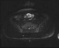 Bicornuate bicollis uterus (Radiopaedia 61626-69616 Axial PD fat sat 5).jpg