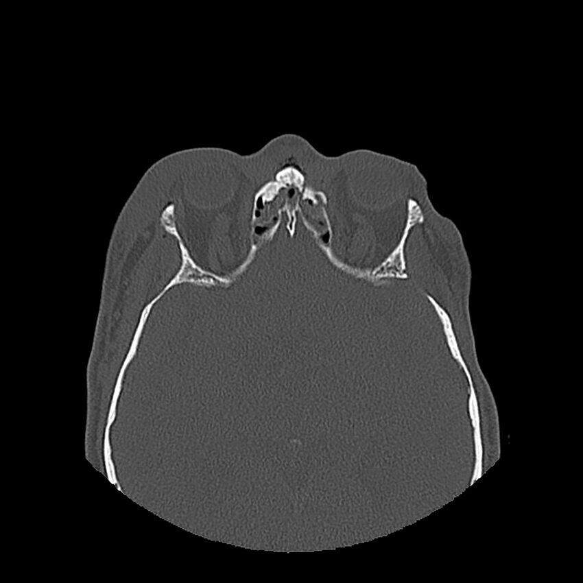 Bilateral Le Fort fractures (Radiopaedia 32192-33135 Axial bone window 70).jpg