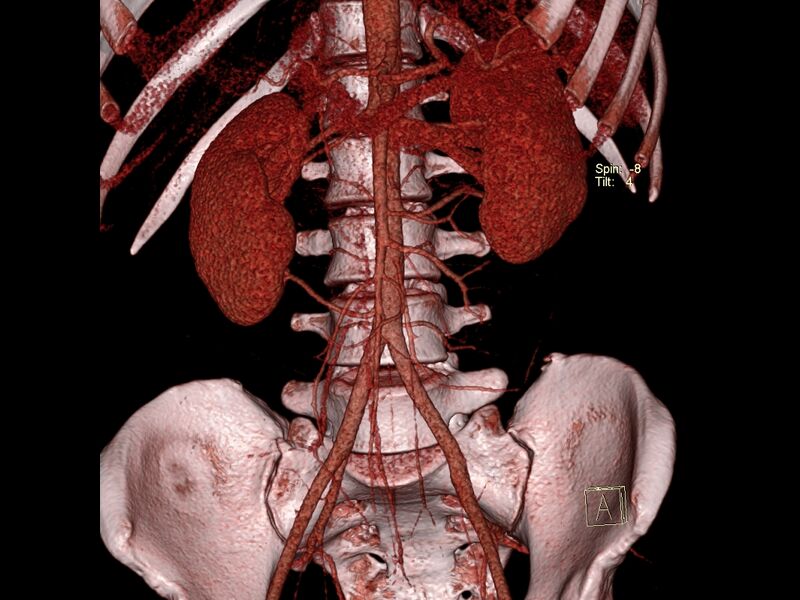 File:Bilateral accessory renal arteries with mild pelvi-ureteric junction (PUJ) obstruction (Radiopaedia 66357-75596 C 1).jpg
