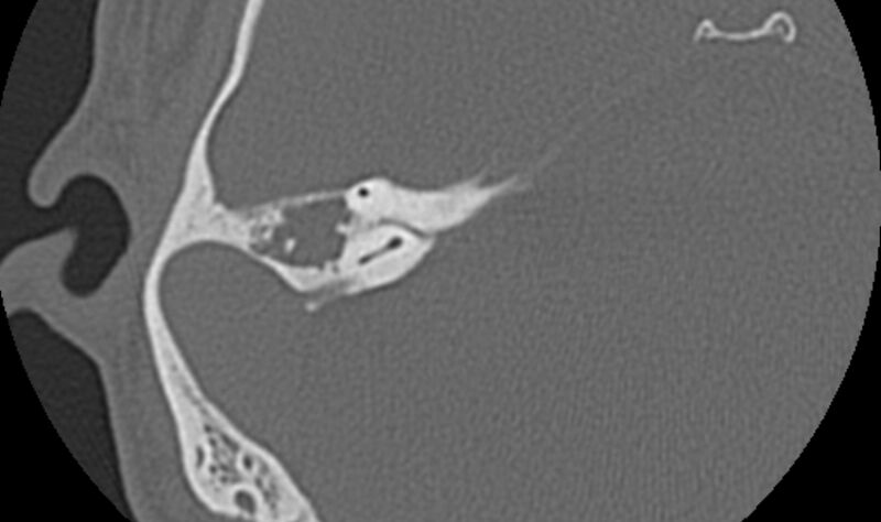 File:Bilateral cholesteatoma (Radiopaedia 54898-61172 Axial bone window 35).jpg