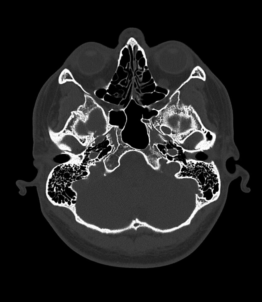 Bilateral medial canal fibrosis (Radiopaedia 85598-101344 Axial bone window 17).jpg