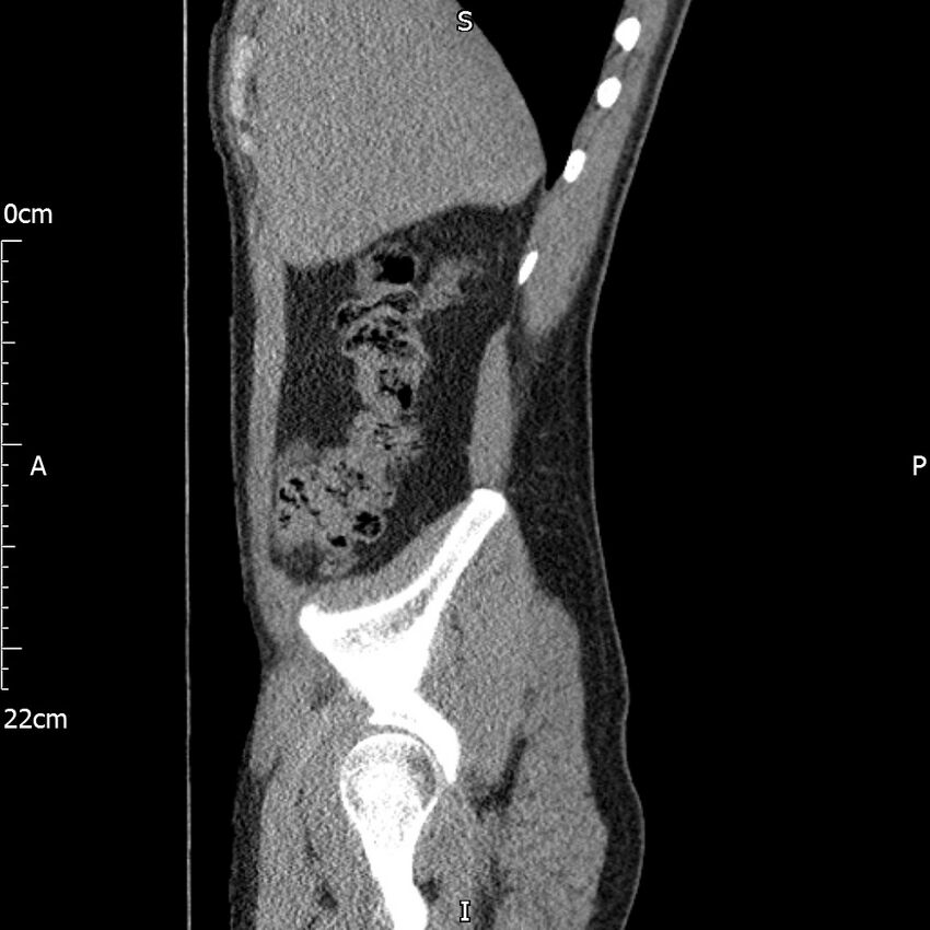 Bilateral medullary nephrocalcinosis with ureteric calculi (Radiopaedia 71269-81569 C 90).jpg