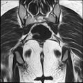 Bilateral ovarian endometriomas (Radiopaedia 87085-103347 Coronal T2 20).jpg