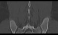 Bilateral pars defect (Radiopaedia 26691-26846 Coronal bone window 39).jpg