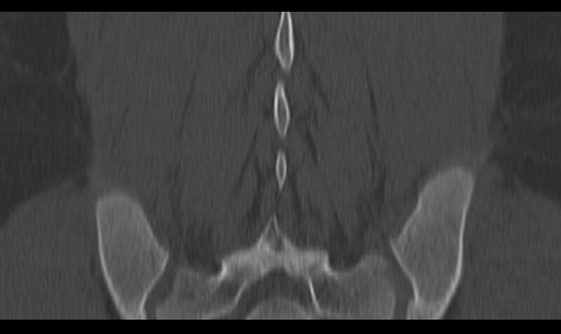 File:Bilateral pars defect (Radiopaedia 26691-26846 Coronal bone window 39).jpg