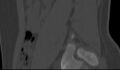 Bilateral pars defect (Radiopaedia 26691-26846 Sagittal bone window 10).jpg
