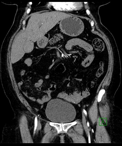 File:Bilateral sporadic synchronous clear cell renal cell carcinoma (Radiopaedia 85035-100575 D 41).jpg