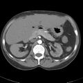 Biliary necrosis - liver transplant (Radiopaedia 21876-21845 A 22).jpg