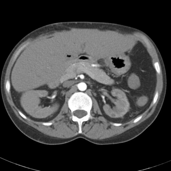 File:Biliary necrosis - liver transplant (Radiopaedia 21876-21845 A 22).jpg