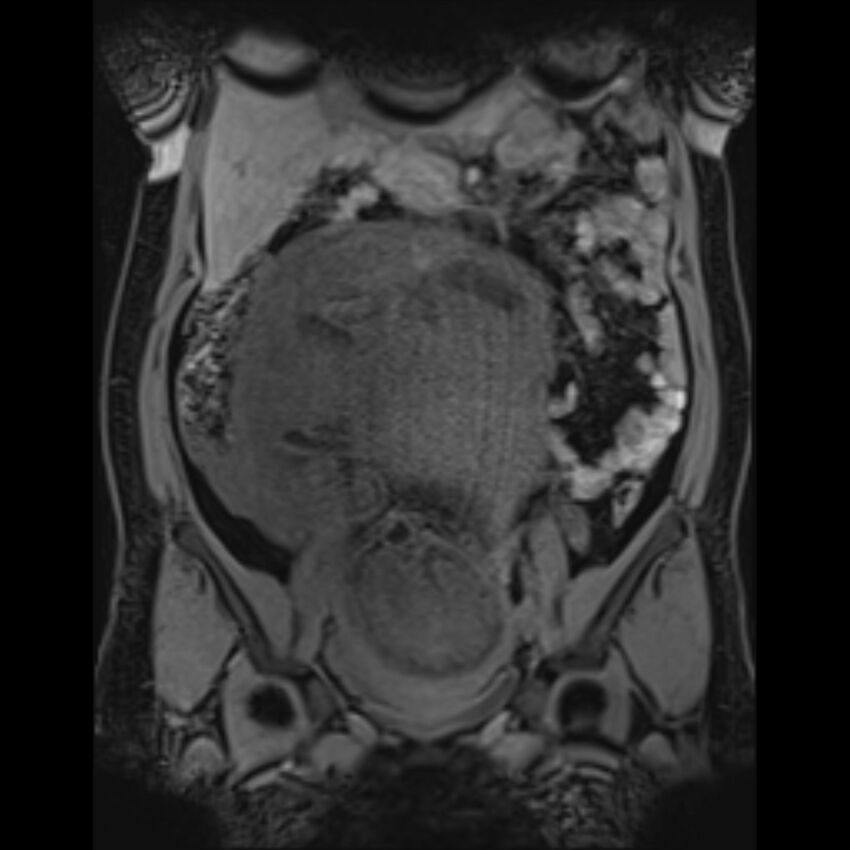 Bilobed placenta accreta (Radiopaedia 69648-79591 Coronal T1 vibe 86).jpg