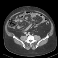 Bladder papillary urothelial carcinoma (Radiopaedia 48119-52951 Axial 35).png