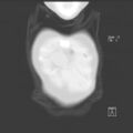 Bochdalek diaphragmatic hernia (Radiopaedia 38866-41059 Coronal lung window 1).jpg