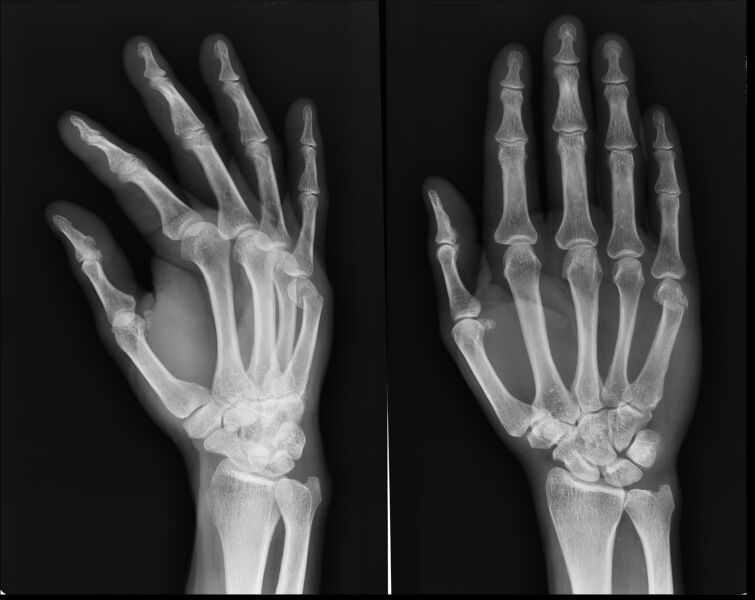File:Boxer's fracture (Radiopaedia 10739-11200 Oblique, frontal 1).jpg