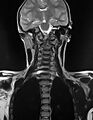 Brachial plexus birth palsy (Radiopaedia 68118-77604 Coronal T2 5).jpg