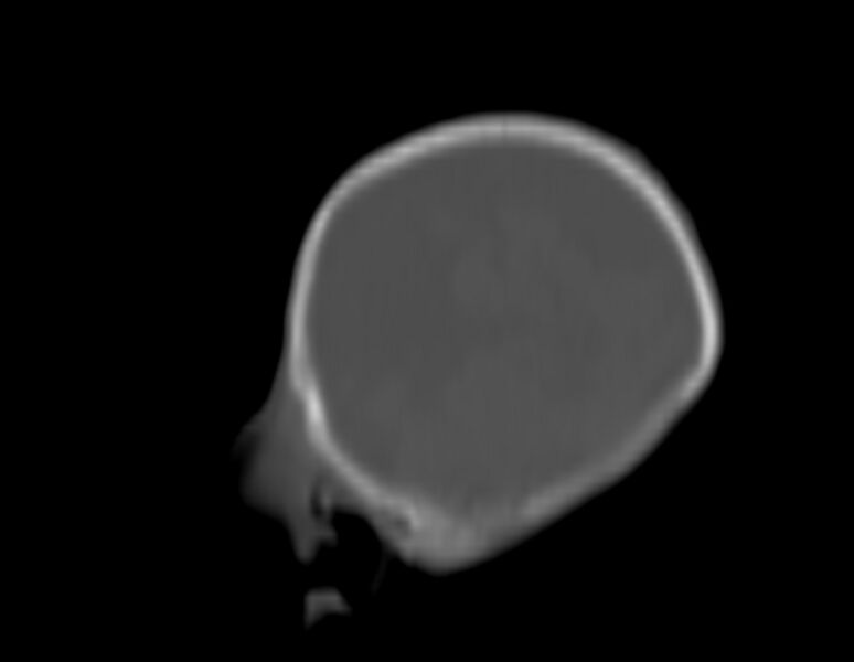 File:Brachycephaly (bi-coronal and bi-lambdoid synostosis) (Radiopaedia 55048-61413 Sagittal bone window 28).jpg