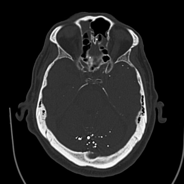 File:Brain Pantopaque remnants (Radiopaedia 78403-91048 Axial bone window 28).jpg