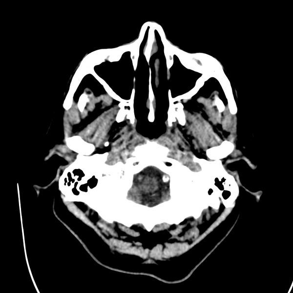File:Brain Pantopaque remnants (Radiopaedia 78403-91048 Axial non-contrast 19).jpg