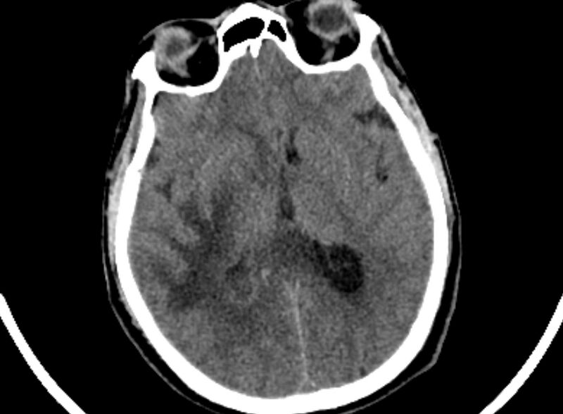File:Brain abscess complicated by intraventricular rupture and ventriculitis (Radiopaedia 82434-96575 Axial non-contrast 45).jpg