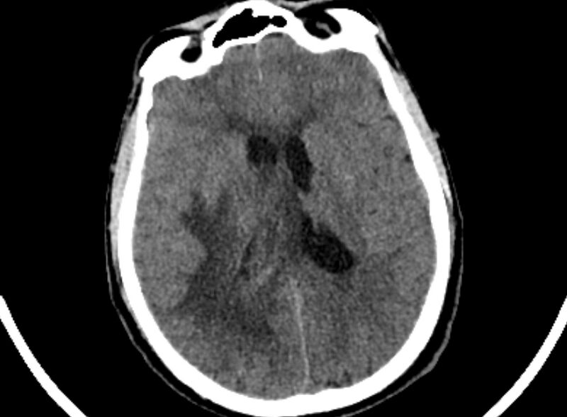 File:Brain abscess complicated by intraventricular rupture and ventriculitis (Radiopaedia 82434-96575 Axial non-contrast 54).jpg