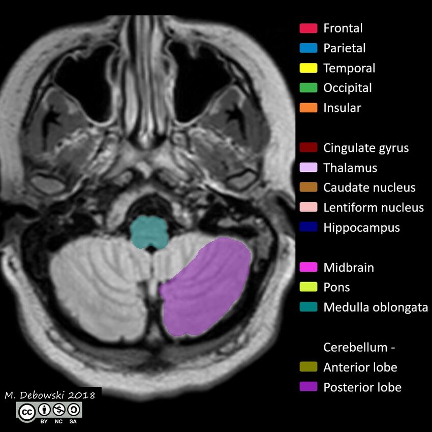 Brain lobes - annotated MRI (Radiopaedia 61691-69700 Axial 68).JPG