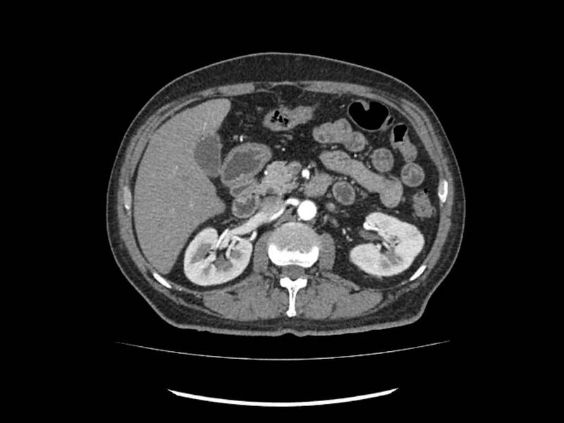 File:Brain metastases from renal cell carcinoma (Radiopaedia 42222-45328 A 77).jpg