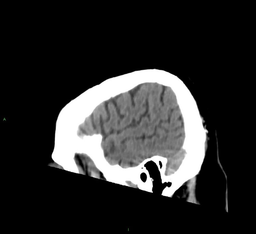 Brainstem hemorrhage (Radiopaedia 58794-66028 C 8).jpg