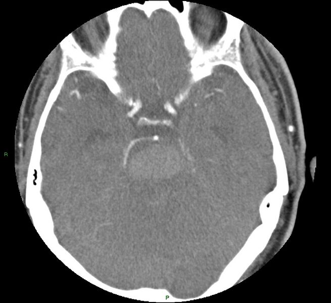 File:Brainstem hemorrhage (Radiopaedia 58794-66028 D 70).jpg