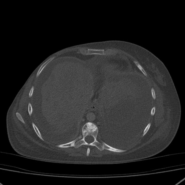 File:Breast cancer metastases - hepatic and skeletal (Radiopaedia 34201-35461 Axial bone window 29).jpg