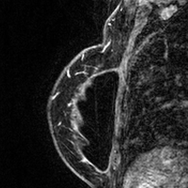 File:Breast implants - MRI (Radiopaedia 26864-27035 Sagittal T2 88).jpg