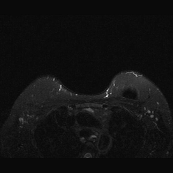 File:Breast implants - MRI (Radiopaedia 26864-27035 T2 SPAIR 43).jpg