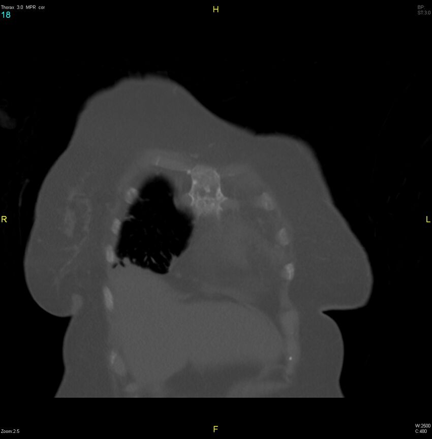 Breast primary with lung and bone metastases (Radiopaedia 40620-43228 bone window 18).jpg