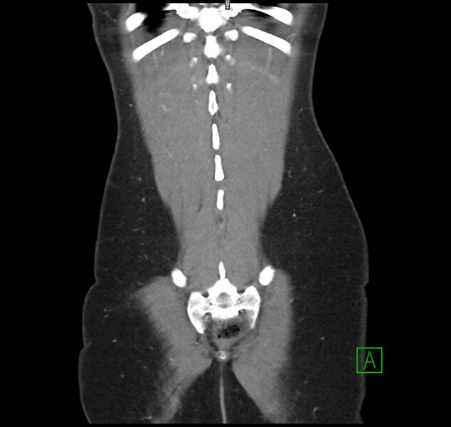 File:Broad ligament hernia (Radiopaedia 63260-71832 B 35).jpg