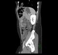 Broad ligament hernia (Radiopaedia 63260-71832 C 41).jpg
