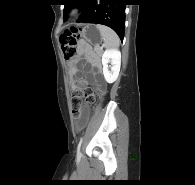 File:Broad ligament hernia (Radiopaedia 63260-71832 C 41).jpg