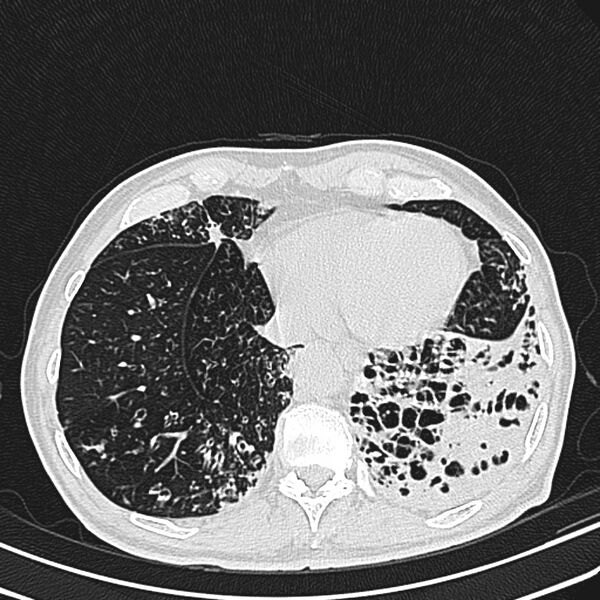 File:Bronchiectasis (Radiopaedia 22061-22059 lung window 23).jpg
