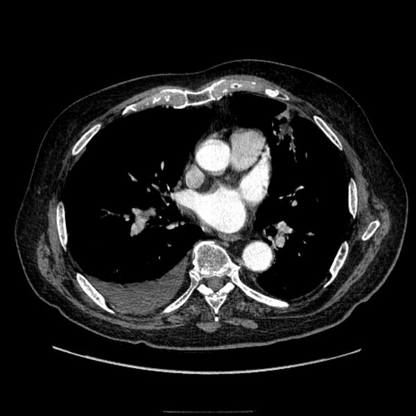 File:Bronchogenic adenocarcinoma and pulmonary embolism (Radiopaedia 9097-9806 D 34).jpg
