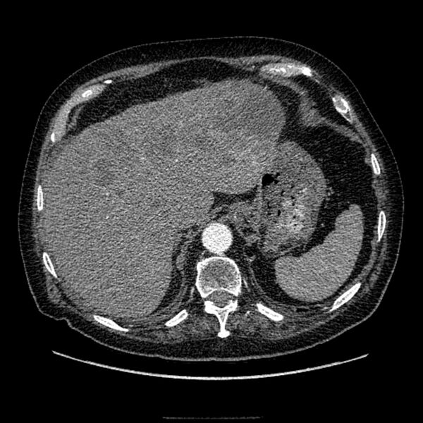 File:Bronchogenic adenocarcinoma and pulmonary embolism (Radiopaedia 9097-9806 D 53).jpg