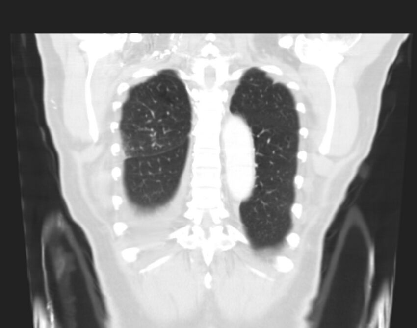 Bronchogenic carcinoma with lymphangitic spread (Radiopaedia 29002-29357 Coronal lung window 61).jpg