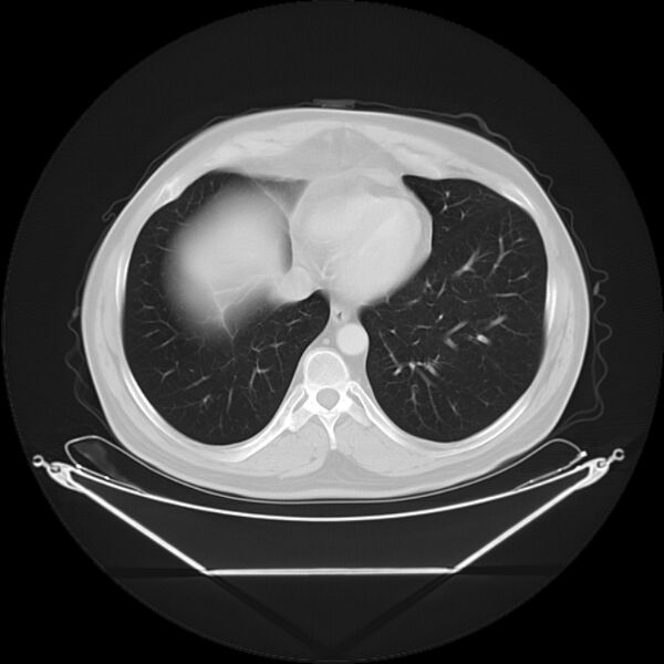 File:Bronchogenic carcinoma with upper lobe collapse (Radiopaedia 29297-29726 Axial lung window 25).jpg