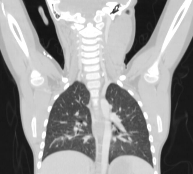 File:Bronchus suis (Radiopaedia 68131-77620 Coronal lung window 23).jpg