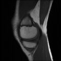 Bucket handle tear - lateral meniscus (Radiopaedia 72124-82634 Sagittal T1 13).jpg
