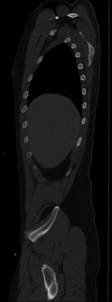 File:Burst fracture (Radiopaedia 83168-97542 Sagittal bone window 33).jpg