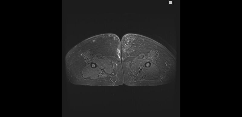 File:Buttock filler complications (Radiopaedia 63497-72115 Axial STIR 35).jpg